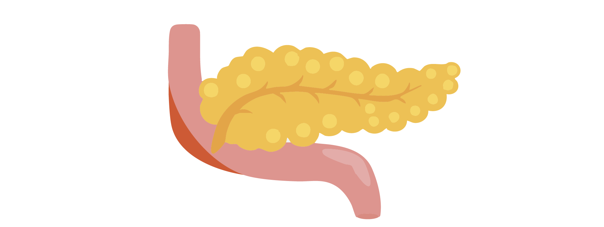 Molybdeen en cadmium negatief en positief geassocieerd met pancreaskanker